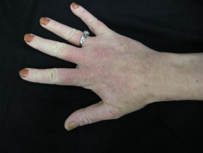 Dermatitis as reaction to artificial nails