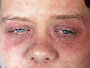 Eyelid dermatitis due to nail enamel allergy