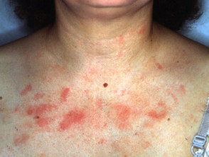 Chest dermatitis due to nail enamel allergy 