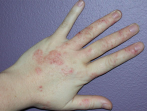 hand dermatitis