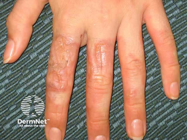 Phototoxic dermatitis from lime juice
