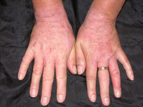 Rubber dermatitis