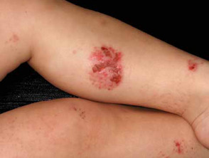 Infected nummular atopic dermatitis