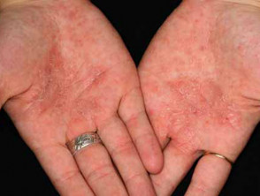 Chronic hand dermatitis