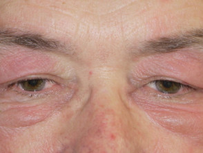 Dermatomyositis of eyelids