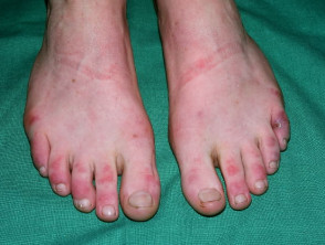 Dermatomyositis of the foot