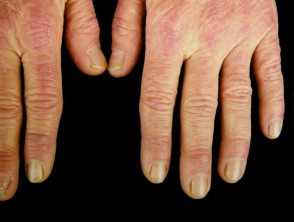 Dermatomyositis of the hand 