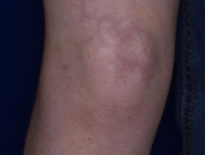 Dermatomyositis of the leg 