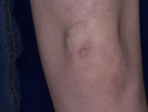 Dermatomyositis of the leg 