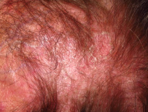 Dermatomyositis of the scalp