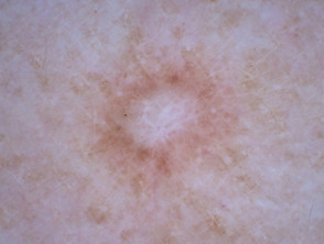Dermatofibroma, polarised dermoscopy view