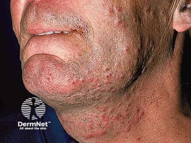 Pseudofolliculitis