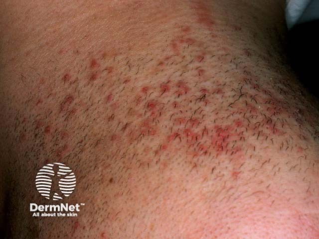 Pseudofolliculitis