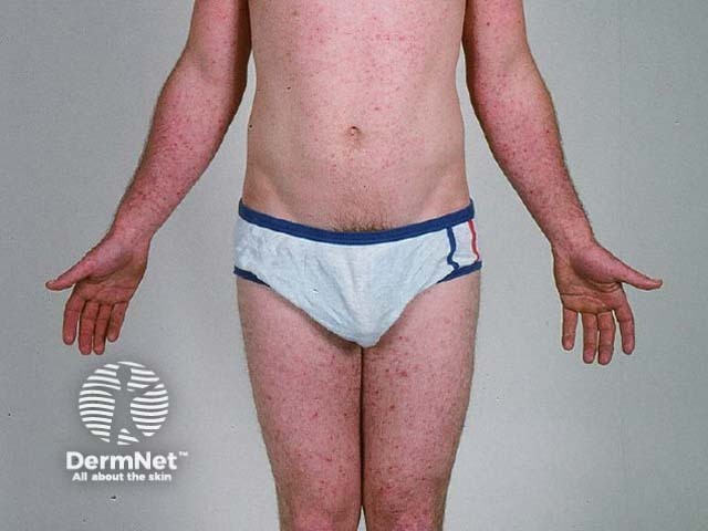 Shearer folliculitis