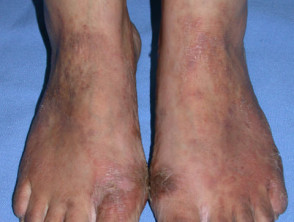 Shoe dermatitis: rubber antioxidant allergy