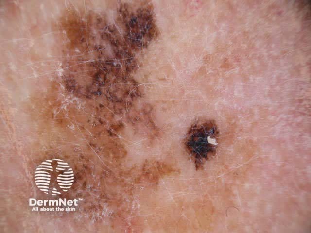Melanoma on the face