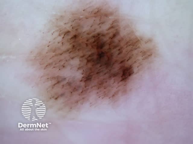 Parallel fibrillar pattern