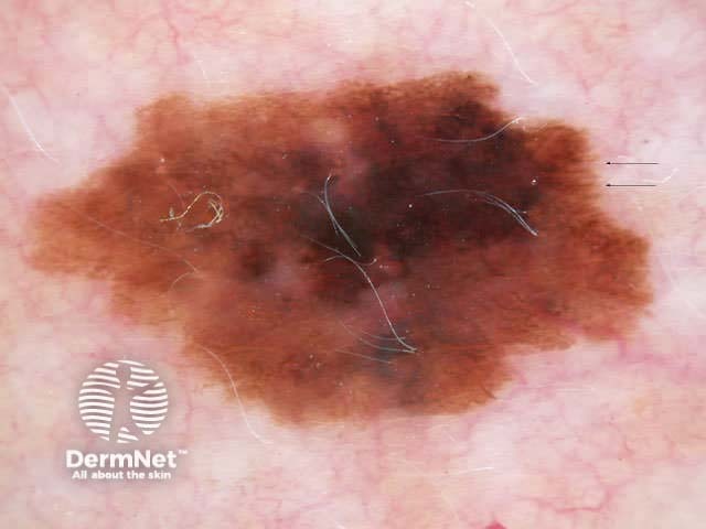 Focal irregular streaking