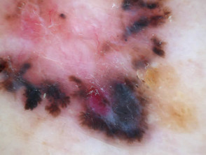 Leaf-like structures in pigmented basal cell carcinoma dermoscopy