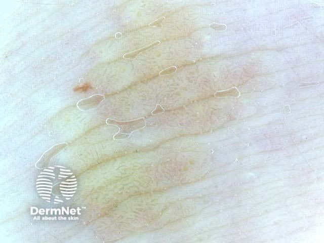 Skin-coloured lesion