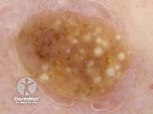 Starry and cloudy milia-like cysts