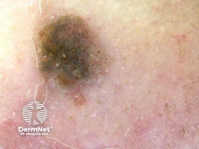 Hairpin blood vessels