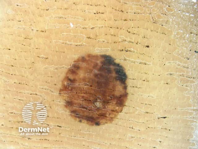 Structureless red/brown parallel ridge pattern