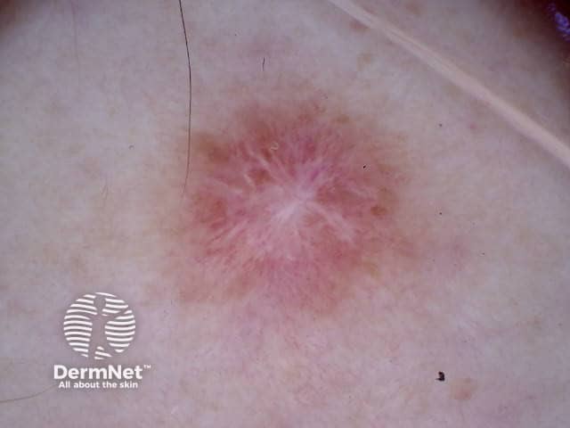 Radial white shiny streaks