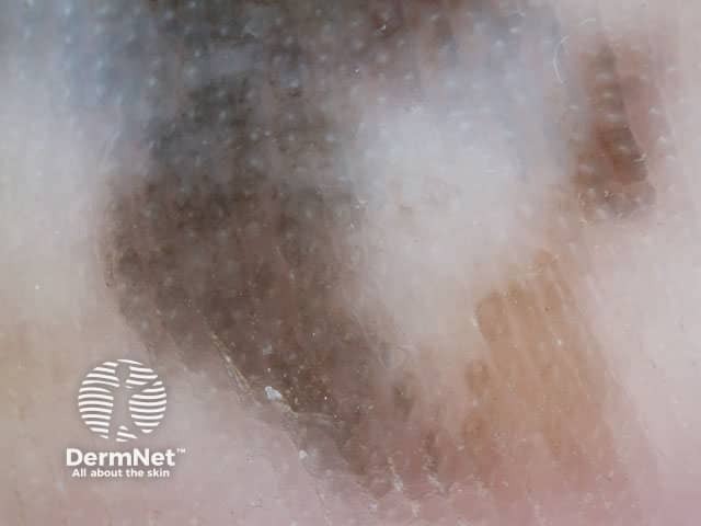 Parallel ridge pattern