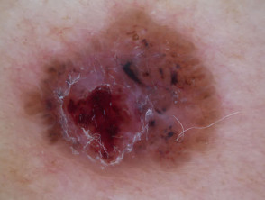 Adherent fibre, leaf-like structures and serpentine vessels in pigmented basal cell carcinoma dermoscopy