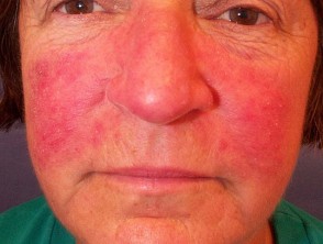 how long to use doxycycline for rosacea
