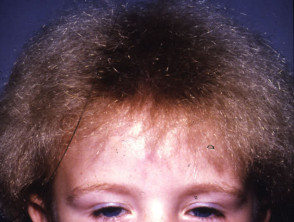 Spangled hair shaft abnormality