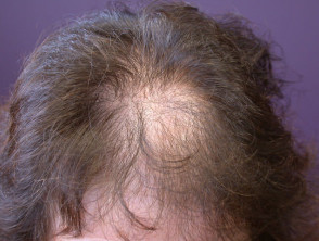 Pattern balding (female) 