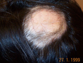 Alopecia areata treated with intralesional steroid injections