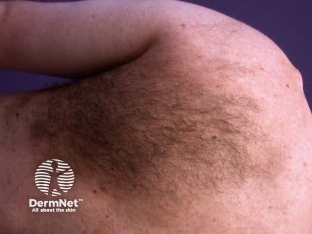 Hair-bearing Becker's naevus