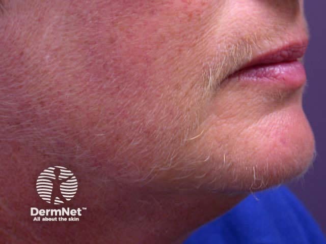 Facial hirsutes