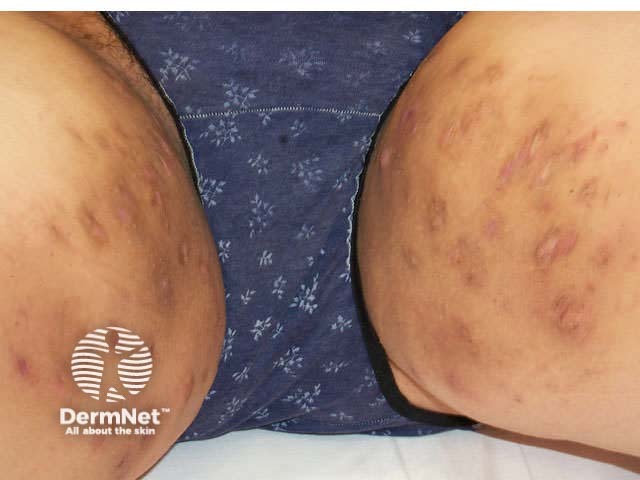 HS in the groins spreading down to the upper thighs