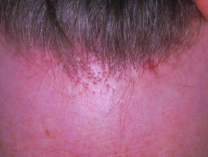 frontal fibrosing alopecia