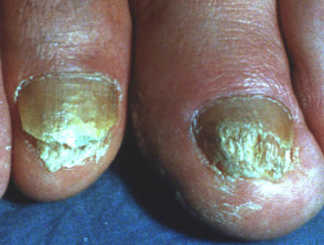 Psoriatic nail