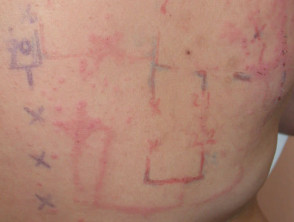 Patch tests: dermatitis to tape