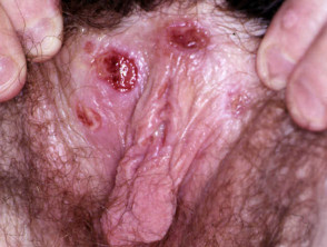 Vulval ulceration in Behcet disease