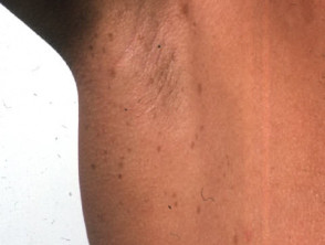 Neurofibromatosis: axillary freckling