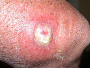 Wound infection after cryotherapy