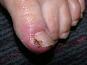 Excessive granulation tissue induced by ingrown toenail