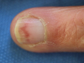 Nail dystrophy induced by hydroxyurea