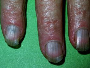 Minocycline induced nail pigmentation