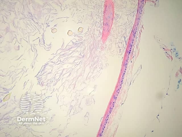 Hair shafts within cyst