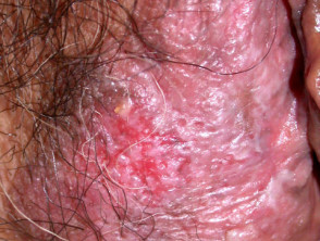 Extramammary Paget disease of the skin of the vulva