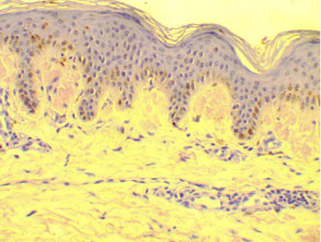 Histology of amyloidosis cutis dyschromica. Congo red