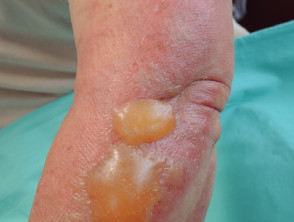Fig dermatitis